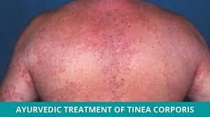 Image result for tinea corporis
