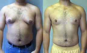 Image result for manboobs