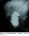 uma <b>bexiga</b> trabeculada,