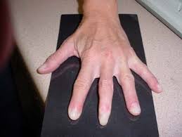 Attēlu rezultāti vaicājumam “Scleroderma”