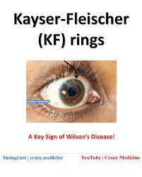 Kuvahaun tulos haulle Kayser-Fleischer