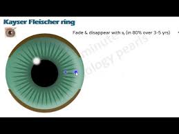 Kuvahaun tulos haulle Kayser-Fleischer