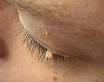 warts