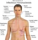 Glandular Fever Symptoms - Natural Infectious Mononucleosis ...
