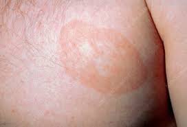 Image result for tinea corporis