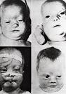with <b>Zellweger syndrome</b>)