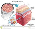 Meningitis. | Dr. Zachary Lahlou