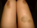 https://www.skinenergizer.com/v/vspfiles/assets/images/bruises.jpg