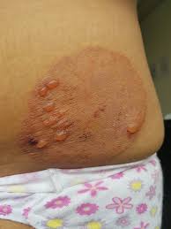 Image result for tinea corporis