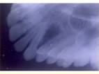 <b>Squamous odontogenic tumour</b>
