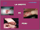 la-greffe-de-<b>peau</b>