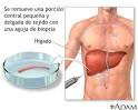 <b>Biopsia</b> de hígado