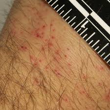 Image result for bed bug bites