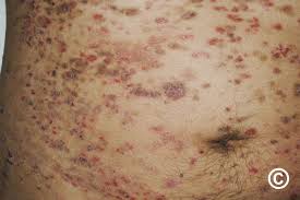 Attēlu rezultāti vaicājumam “Pemphigus borealis”