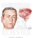 <b>Parotitis</b> and Mumps