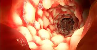 Image result for boala crohn si schizofrenie paranoida