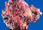 Imaging of Pure Primary Ovarian Choriocarcinoma