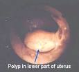 Hysteroscopy FAQ: diagnostic hysteroscopy, office hysteroscopy ...