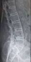 Ankylosing spondylitis - Wikipedia, the free encyclopedia