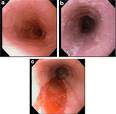 Figure 4 | Eosinophilic esophagitis : GI Motility online