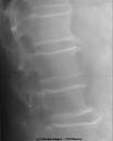 <b>HYPEROSTOSE</b> VERTEBRALE