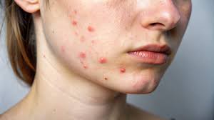 Attēlu rezultāti vaicājumam “Lamproderma columbinum young”