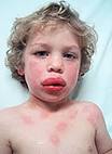 Why Should My Child's Classroom Be Peanut Free? « Onespot Allergy Blog