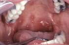 Oral Disease in AIDS : Canker Sores (Hardin MD / CDC)