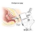 Colposcopy | Golden Gate OBGYN &amp; Skin Center