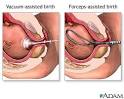 Labor and delivery - Procedures That May Take Place During Labor ...