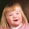 Downs syndrome Symptoms and Prevention