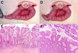Attēlu rezultāti vaicājumam “Diderma umbilicatum young”