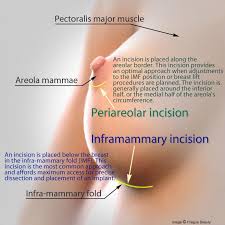 Breast Augmentation Incisions to insert Breast Implants