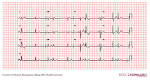 <b>Premature atrial</b> complexes1.