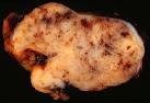 File:Gastrointestinal Stromal Tumor (GIST) of Stomach.jpg ...