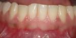 Bestand:Healthy gingiva.jpg - Wikipedia