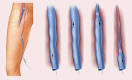 Endovenous Laser Treatment | CRL