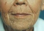 Explore Plastic Surgery - Dr. Barry Eppley lip wrinkles 