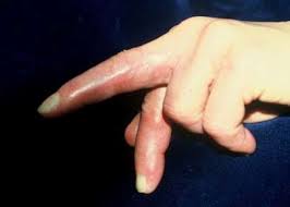 Attēlu rezultāti vaicājumam “Scleroderma”