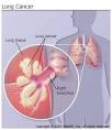 What is Lung Cancer? - WebMD