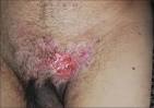 Primary <b>extramammary Paget's disease</b> with extensive skeletal