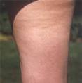 cellulite pictures