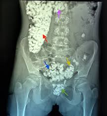 Attēlu rezultāti vaicājumam “Diderma umbilicatum young”
