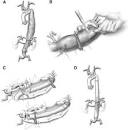 The Elephant Trunk Technique for Staged Repair of Complex