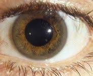 Kuvahaun tulos haulle Kayser-Fleischer