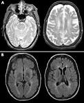 <b>Niemann</b>-<b>Pick disease type C</b>: