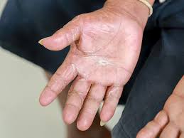 Attēlu rezultāti vaicājumam “Scleroderma”