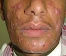Dermatology - FACE: acne