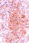 CD1a by <b>Langerhans cells</b>.