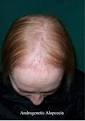 Causes of Hair Loss in Women